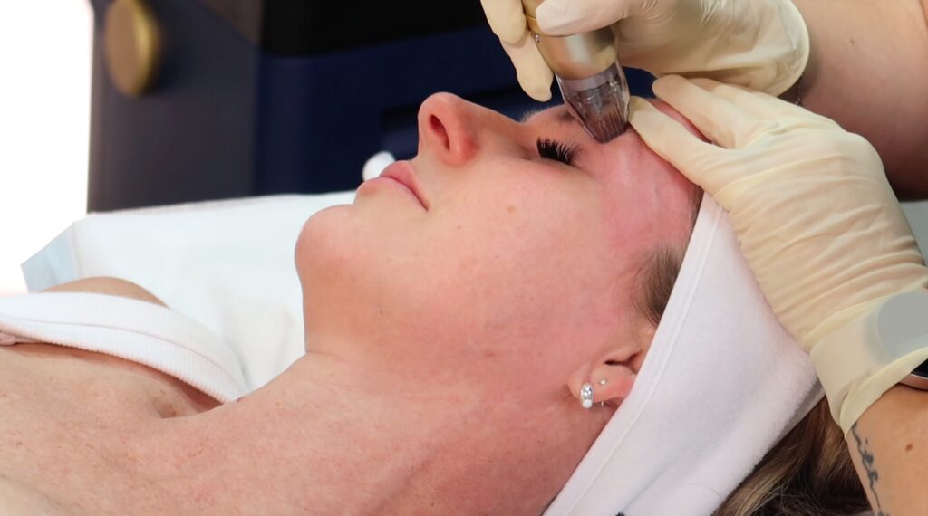 Sylfirm X Treatment Perth Fresh Skin Clinic Perth (1)